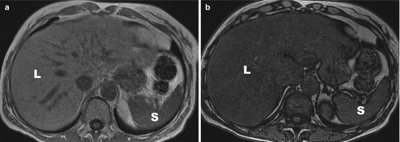 overview-of-ct-and-mri-techniques-of-the-liver-radiology-key