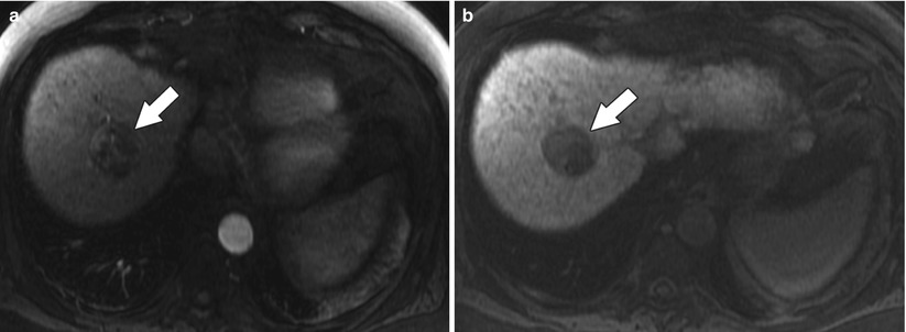 The Biliary Tree | Radiology Key