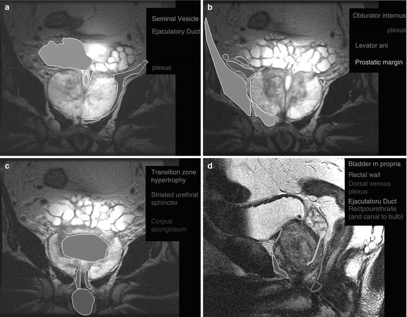 enlarged prostate x ray