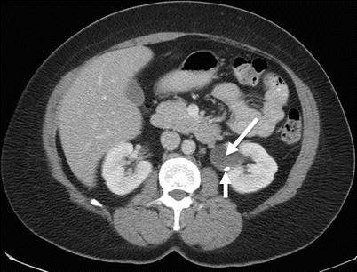 Extrarenal Pelvis