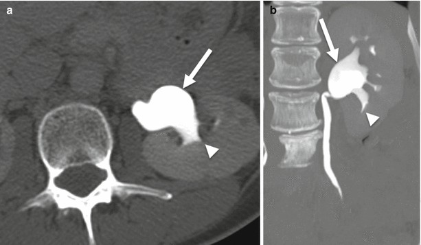 extrarenal pelvis