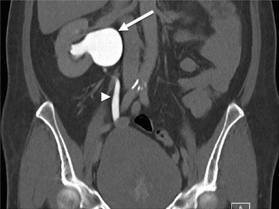 extrarenal pelvis