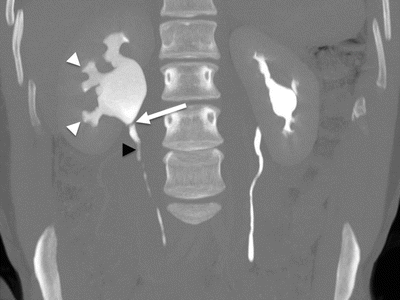 extrarenal pelvis