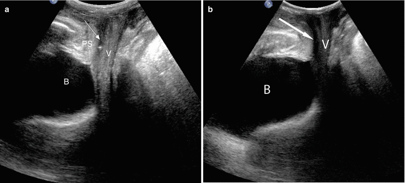 urethral diverticulum ultrasound