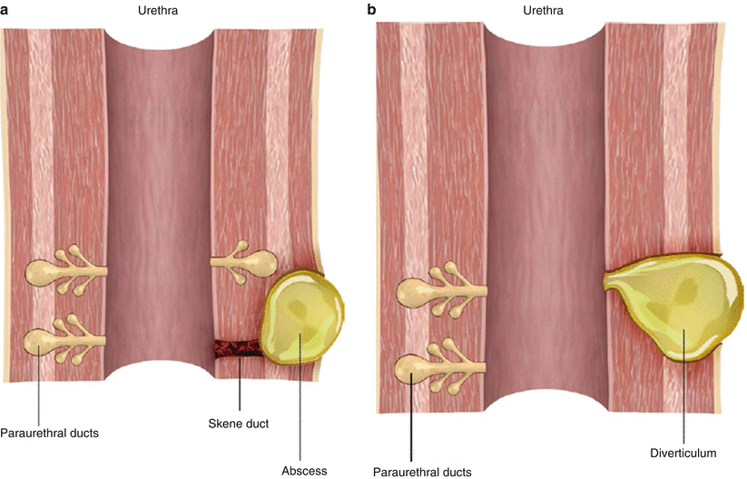 Urethral Opening Swollen Female