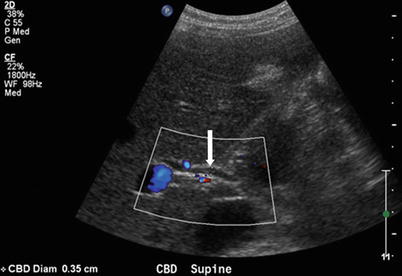 Sonographic Measurement Of Normal Common Bile Duct Diameter, 50% OFF