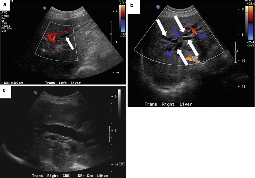 Biliary Tree Dilatation Ultrasound Image Radiopaediaorg Biliary Tree Dilatation Ultrasound Image Radiopaediaorg