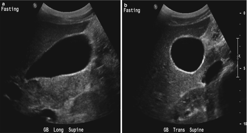 abnormal gallbladder ultrasound