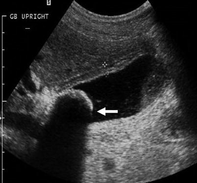 The Gallbladder | Radiology Key