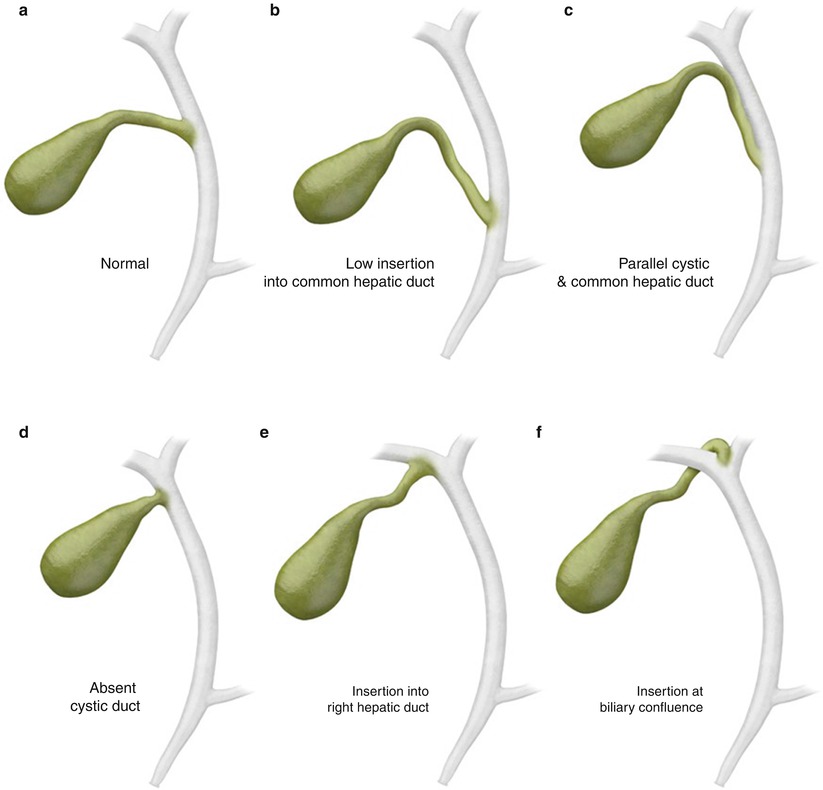 The Gallbladder | Radiology Key