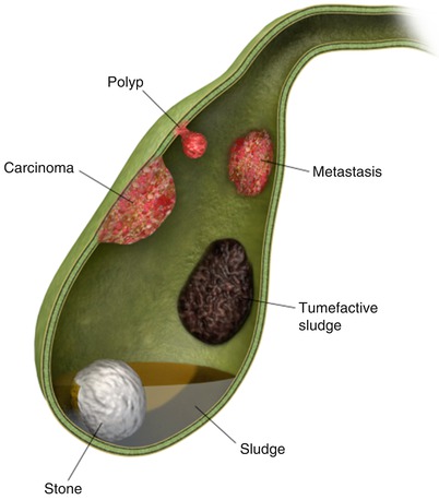 gallbladder stone bile ultrasound duct anatomy sludge pouch hartmann gall bladder gallstones illustration fig most medical portion sonography filling liver