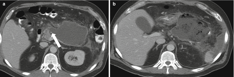 The Pancreas | Radiology Key