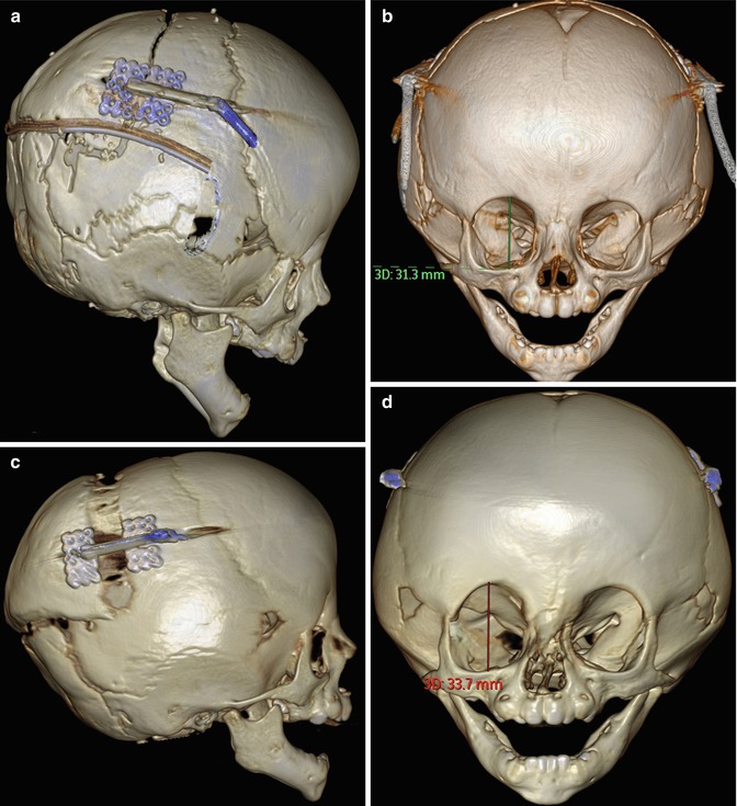 Imaging Of Strabismus And Craniofacial Malformation Surgery | Radiology Key