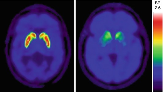 Parkinson Dementia: PET Findings | Radiology Key