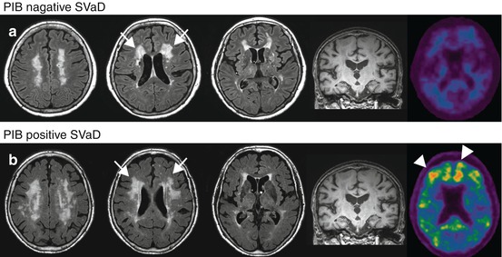 Vascular Dementia | Radiology Key