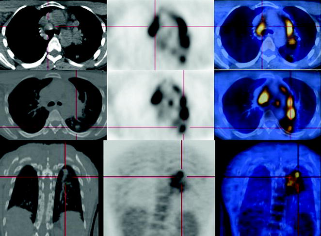 Non Hodgkin Lymphoma Diagnosis Radiology Key