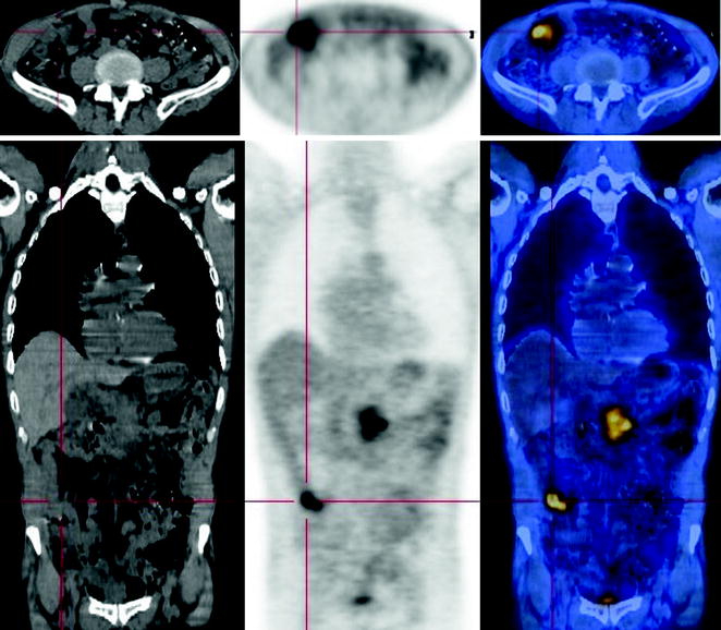 Pancreatic Adenocarcinoma Diagnosis Radiology Key 6323