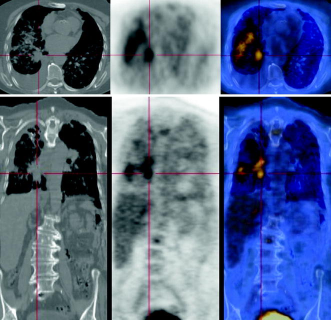 Pulmonary Nodule in Patient with Severe Interstitial Fibrosis ...