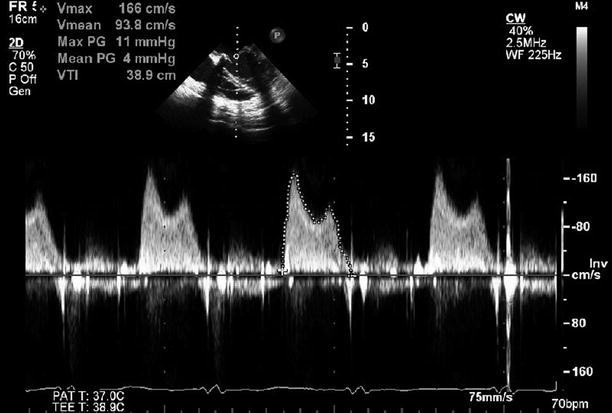 Mitral Valve Prostheses | Radiology Key