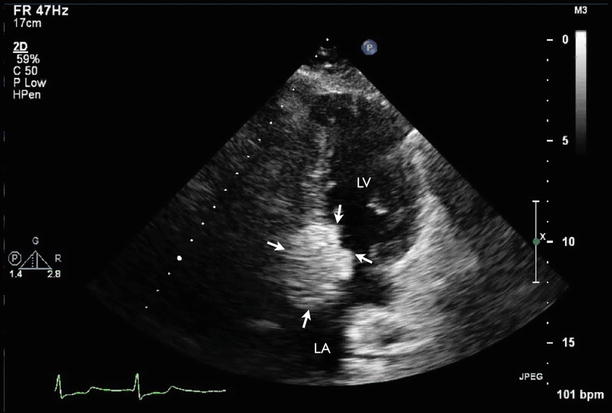 Calcific Degenerative Mitral Disease | Radiology Key