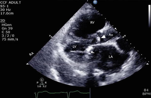 Rheumatic Mitral Valve Disease | Radiology Key