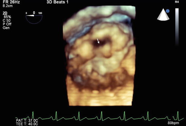 Rheumatic Mitral Valve Disease | Radiology Key