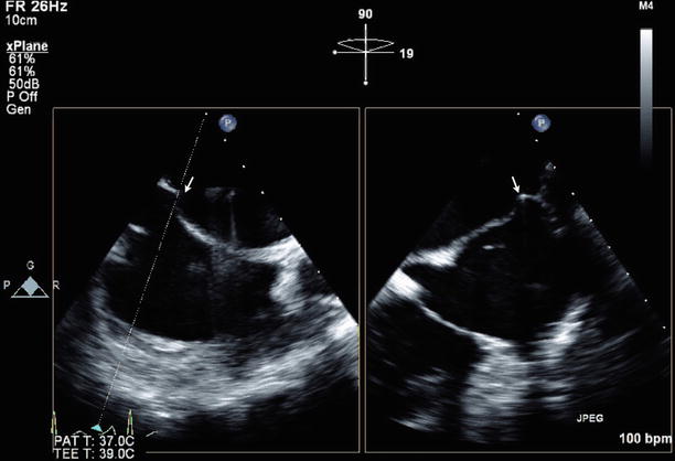 Rheumatic Mitral Valve Disease | Radiology Key