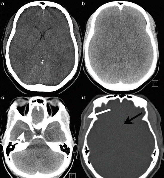 Imaging of Intracranial Vessels | Radiology Key