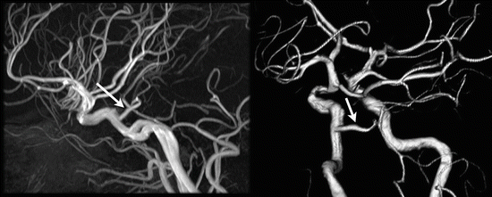 Imaging of Intracranial Vessels | Radiology Key