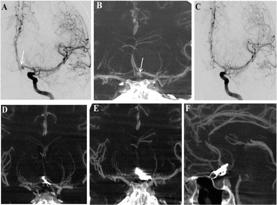 Flat Panel Detector CT Angiography for the Assessment of Intracranial ...