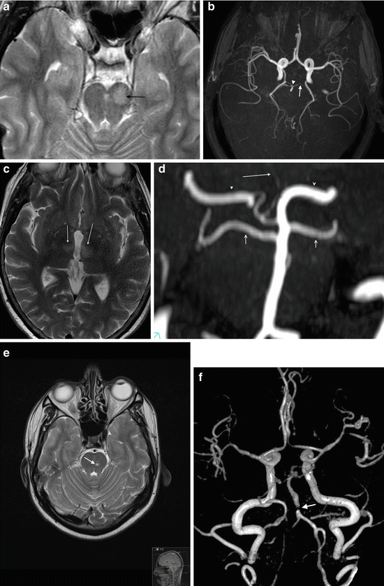 of Intracranial Atherosclerosis | Radiology Key