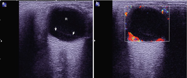 HIV/AIDS Related Eye Diseases | Radiology Key