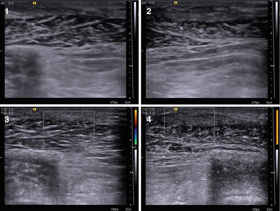 Anatomy, Physiology, and Development of the Male Breast | Radiology Key