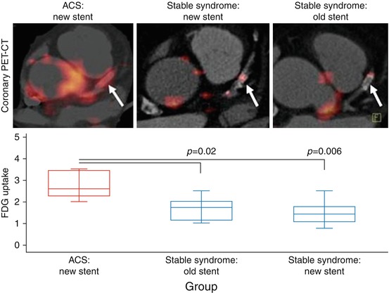 PET/CT Imaging of Inflammation and Calcification | Radiology Key