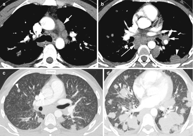 mediastinal-disease-with-acute-symptoms-noncardiac-radiology-key