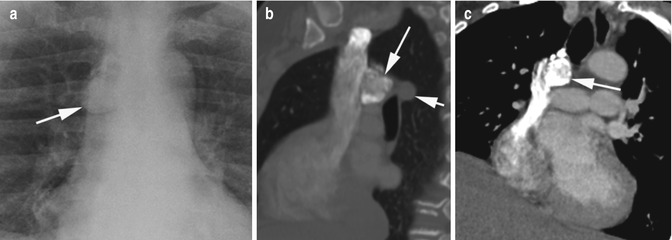 Vascular Dissection | Radiology Key