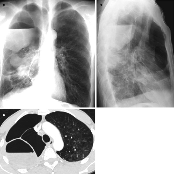 Parenchymal Lung Disease Radiology Key