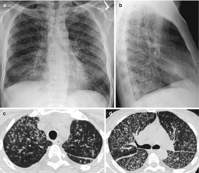 acute-lung-parenchymal-changes-radiology-key