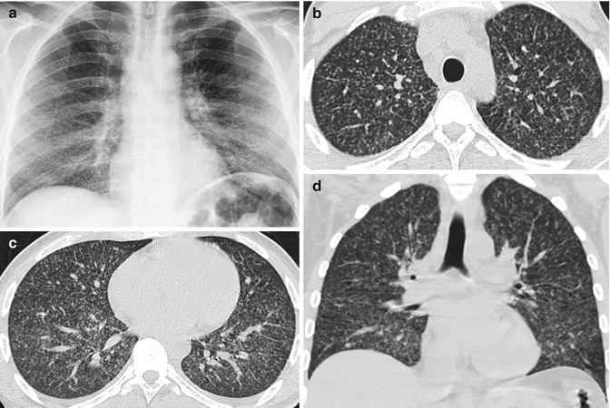 Acute Lung Parenchymal Changes | Radiology Key