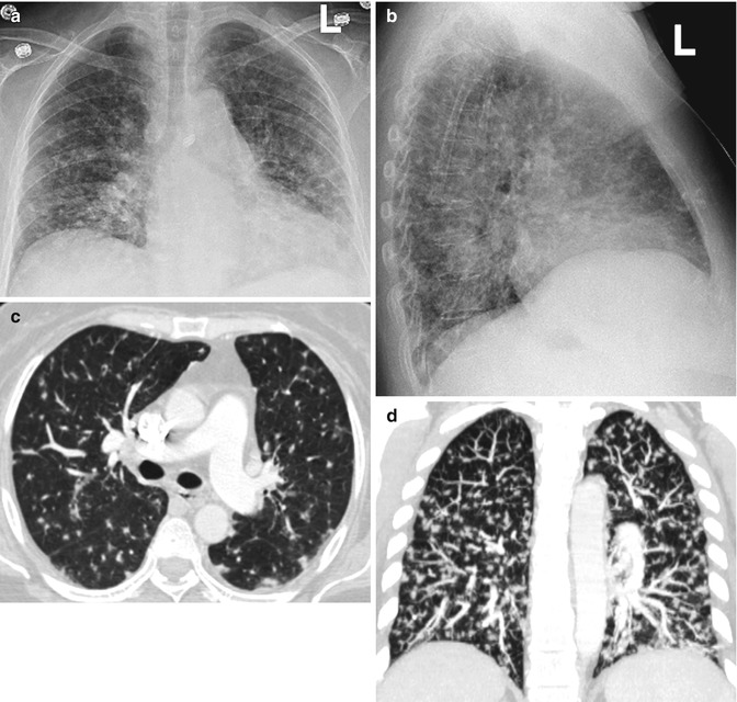 7 Diffuse Parenchymal Lung Disease Thoracic Key