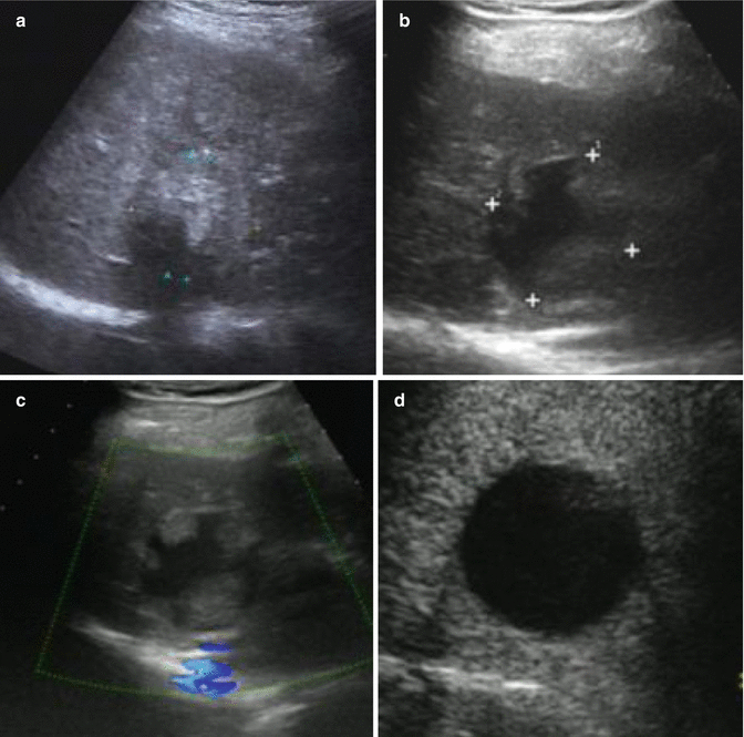 Radiological Assessment And Follow Up After Radiofrequency Ablation