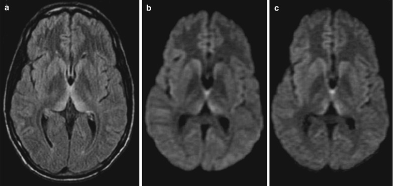 creutzfeldt-jakob-disease