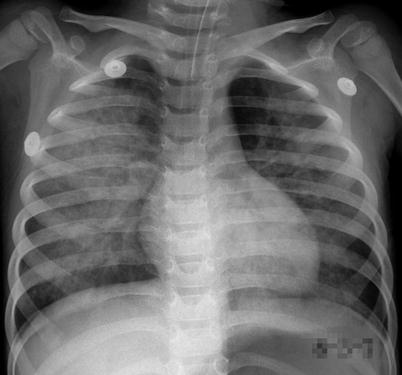 Hand-Foot-Mouth Disease | Radiology Key