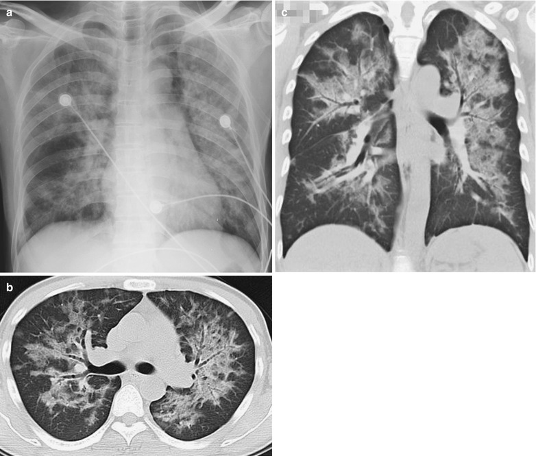 Influenza | Radiology Key