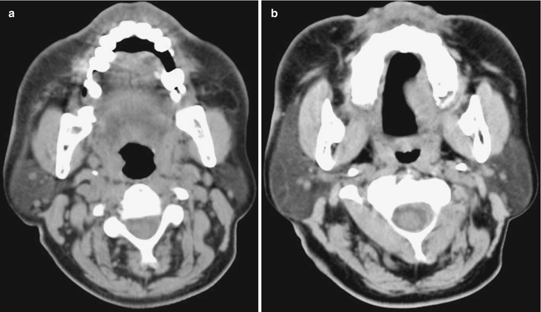 Leprosy | Radiology Key