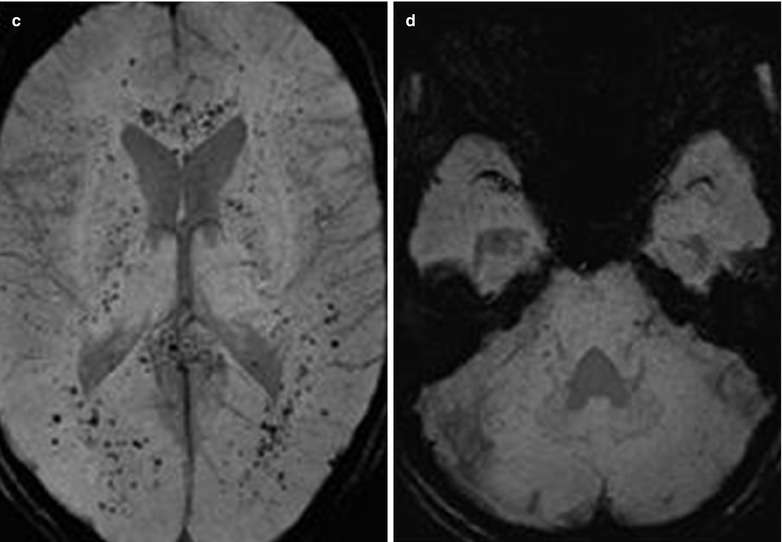 Leptospirosis Radiology Key 8907