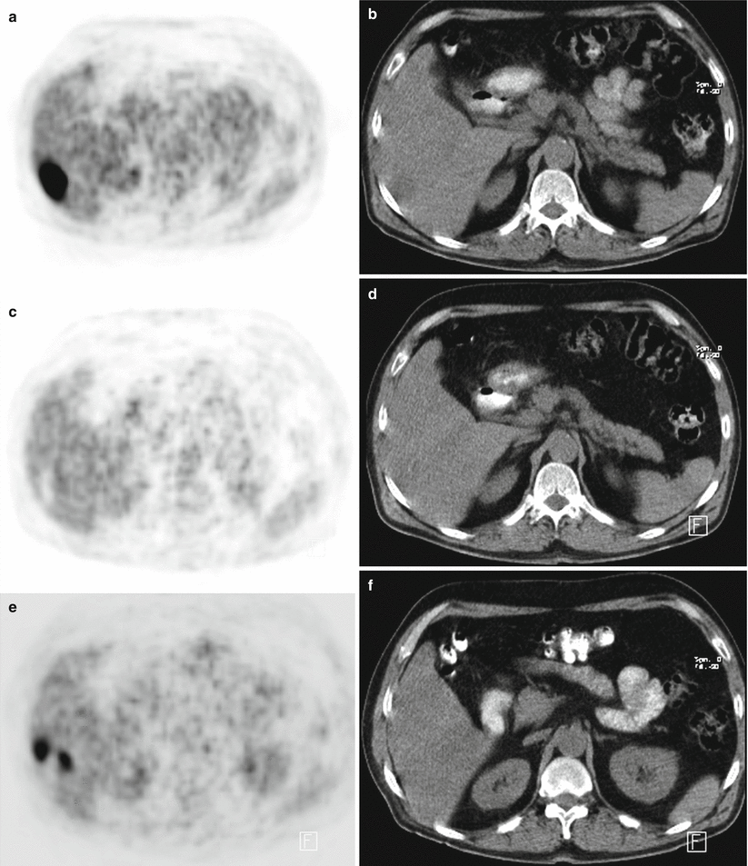 Liver Tumors Radiology Key 