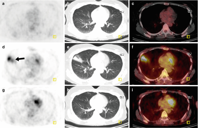 Lymphoma | Radiology Key