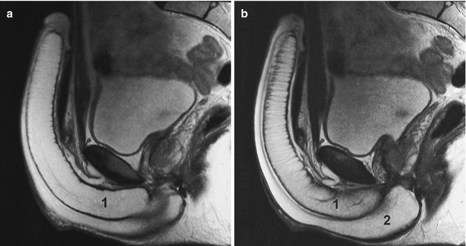 Male Reproductive Organs Radiology Key