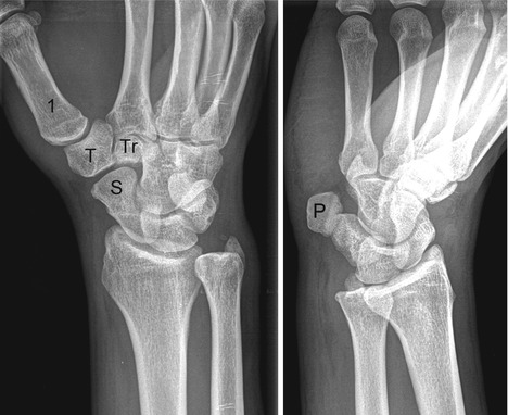 Joints | Radiology Key